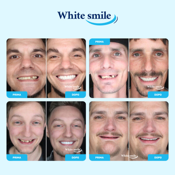 Denti finti WhiteSmile - immagine 3